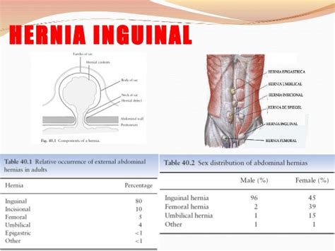 hernia inguinal cie 10 complicaciones